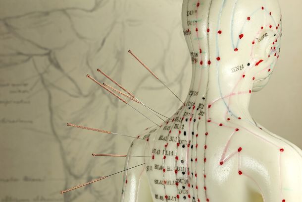 medical-acupuncture