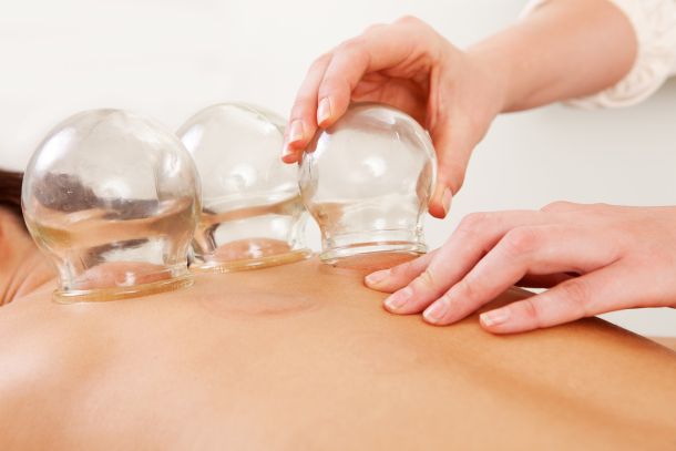 cupping-therapy